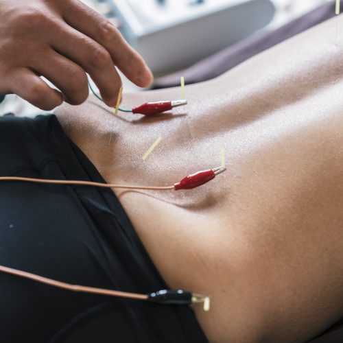 Therapist Giving acupuncture Treatment To Young Asian Woman